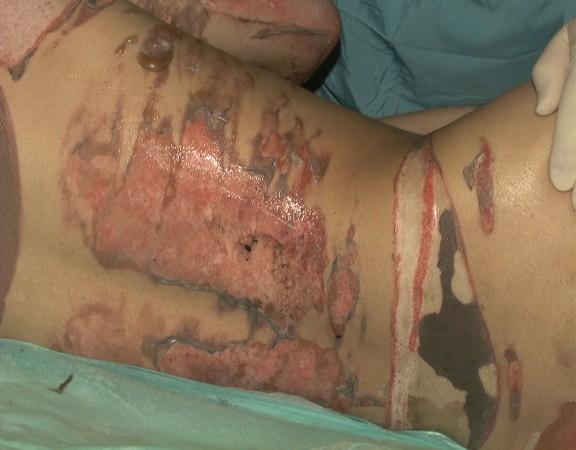 Vebrennungen 2. und 3. Grades - © Bergmannsheil Bochum